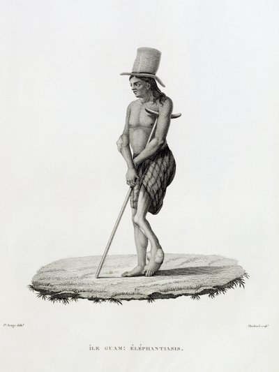 Guam: Een Man met Elephantiasis, uit 